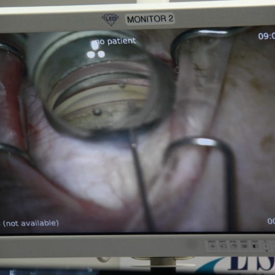 Microincisional Glaucoma Surgery (MIGS)
