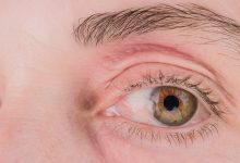 Pterygium Surgery Recovery Time | Pterygium Surgery Recovery | What to Avoid After Pterygium Surgery